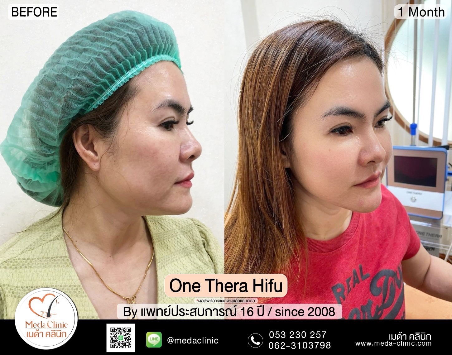 รีวิว onetherahifu