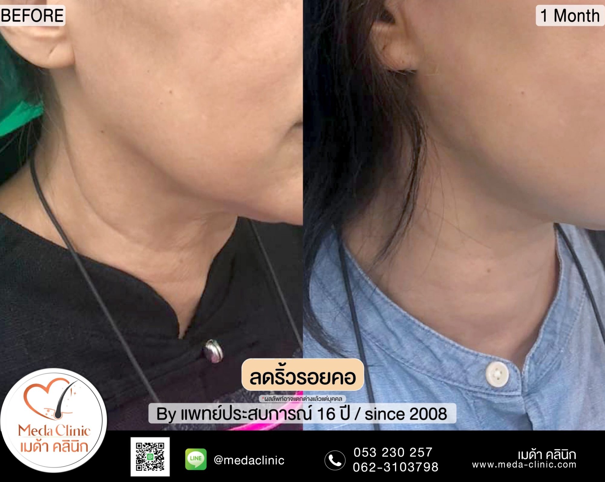 ลดริ้วรอยคอเชียงใหม่