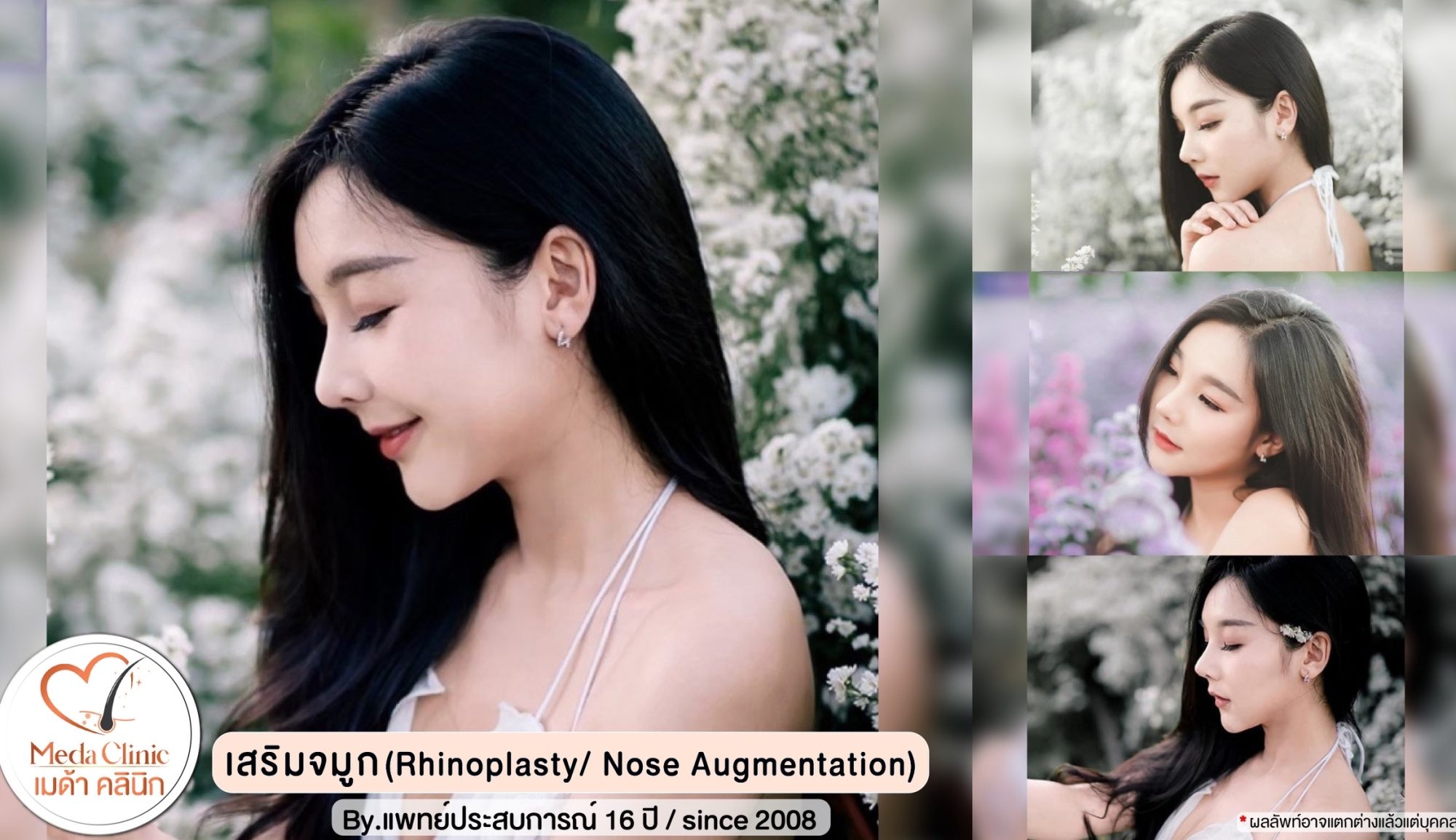 รีวิวเสริมจมูก