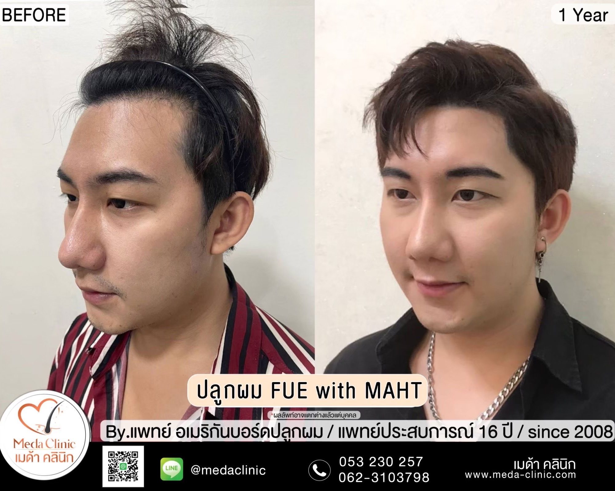 ปลูกผม