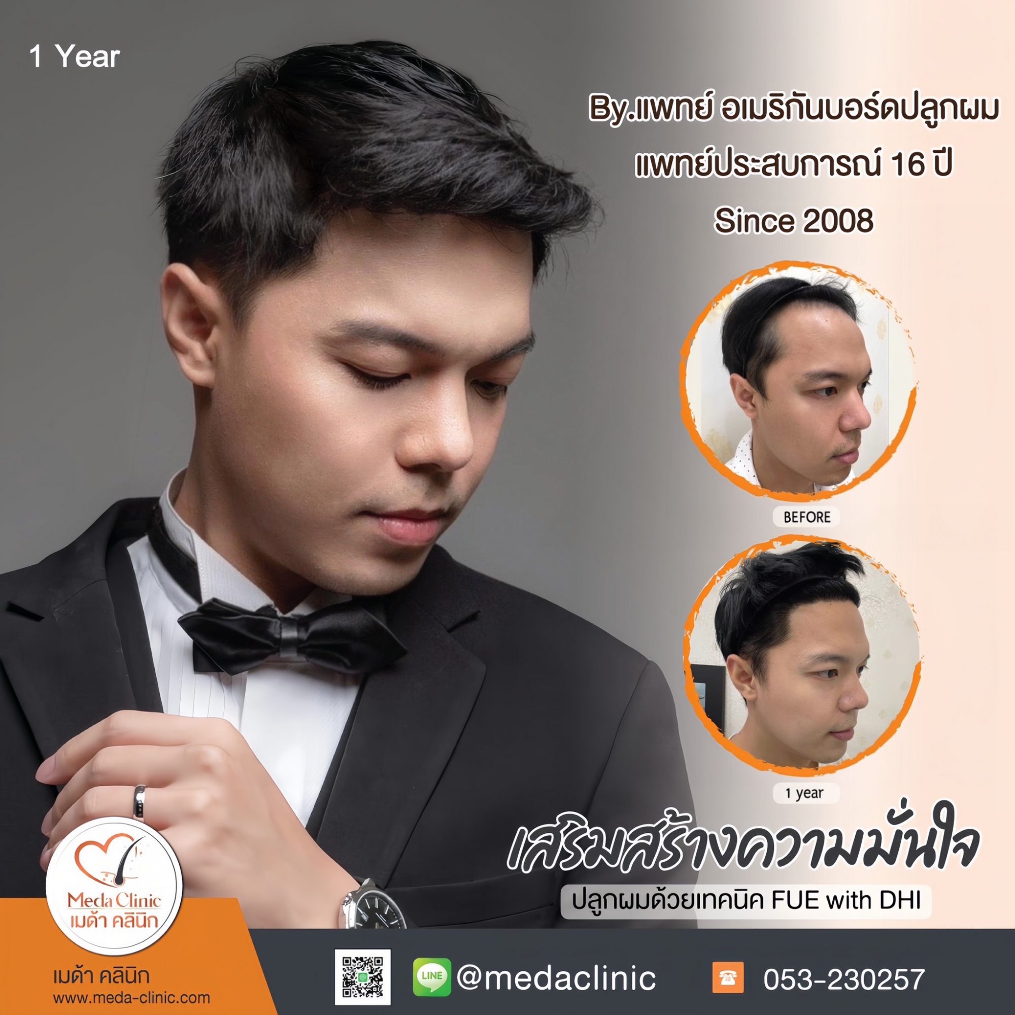 ปลูกผม