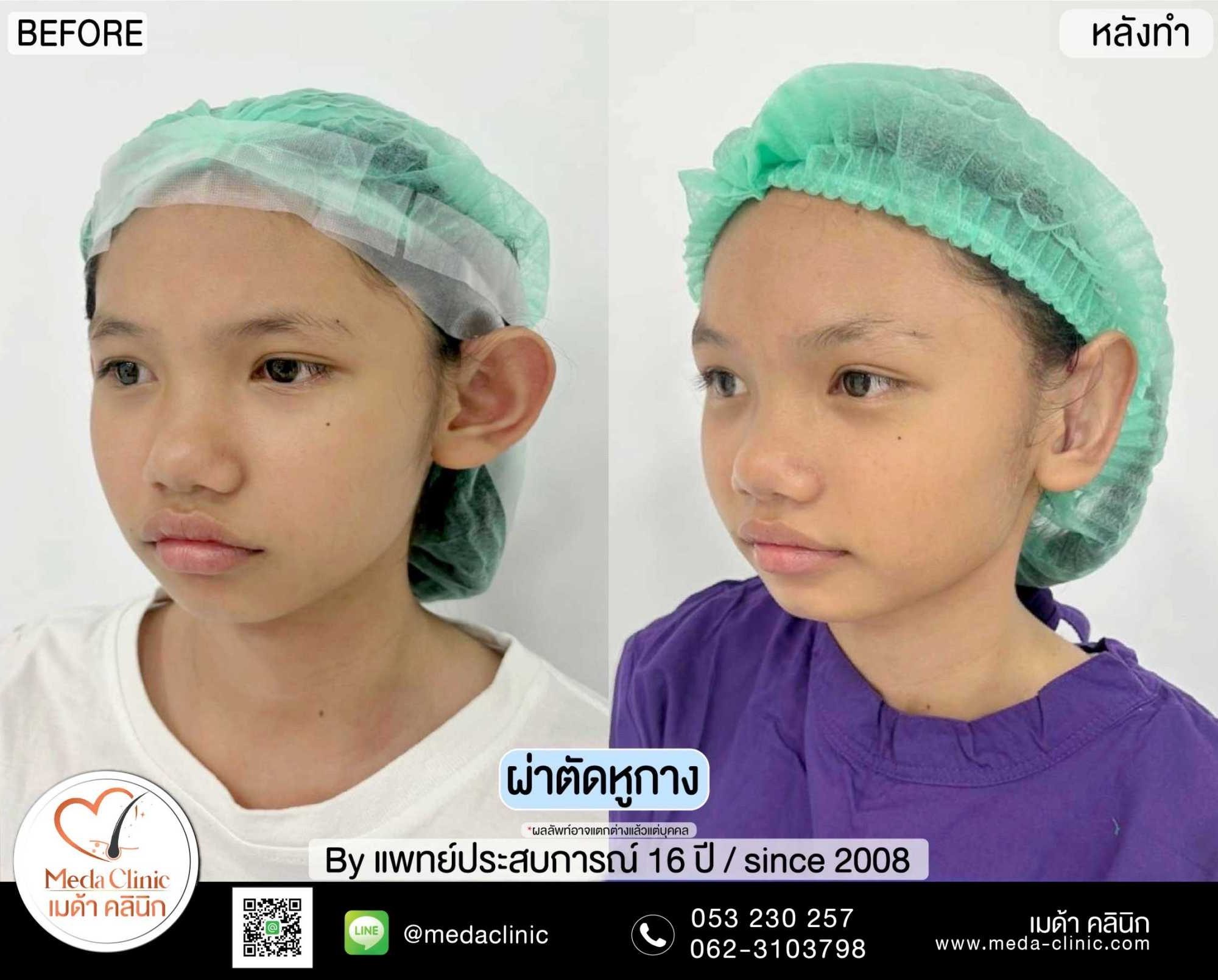 แก้หูกาง ดรุงเทพ
