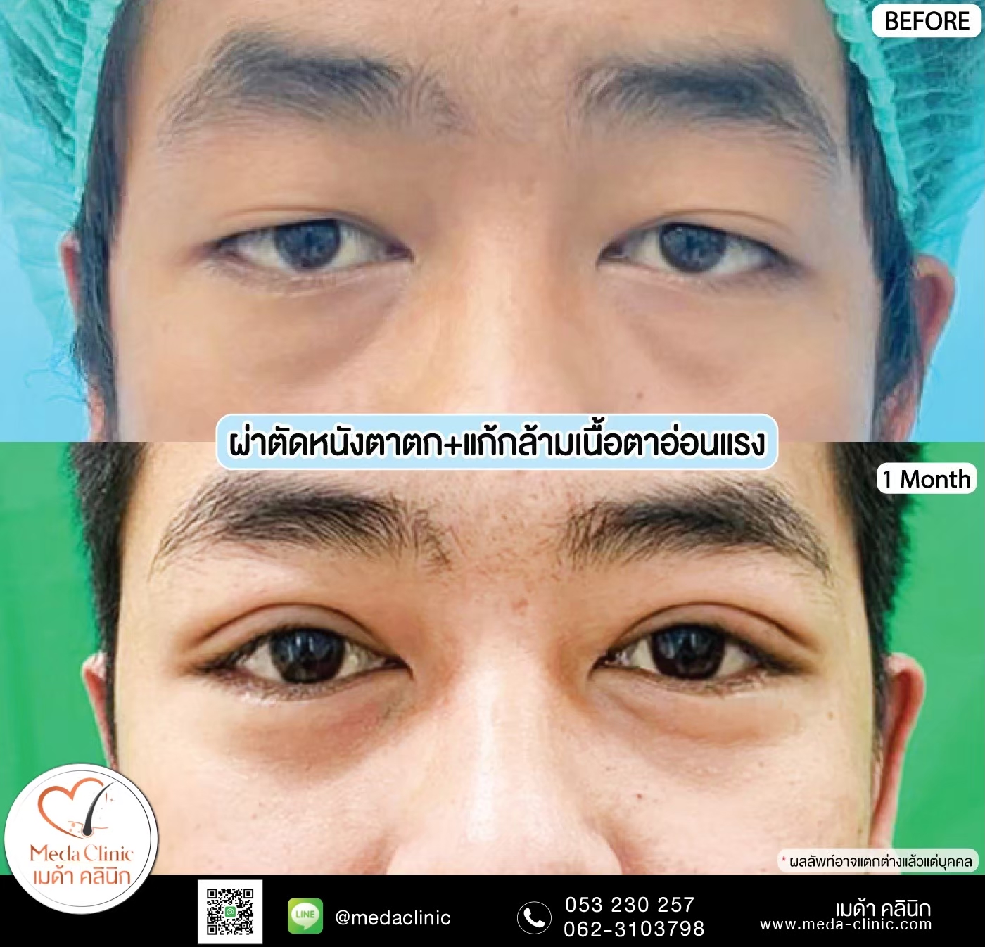 upper Blepharoplasty