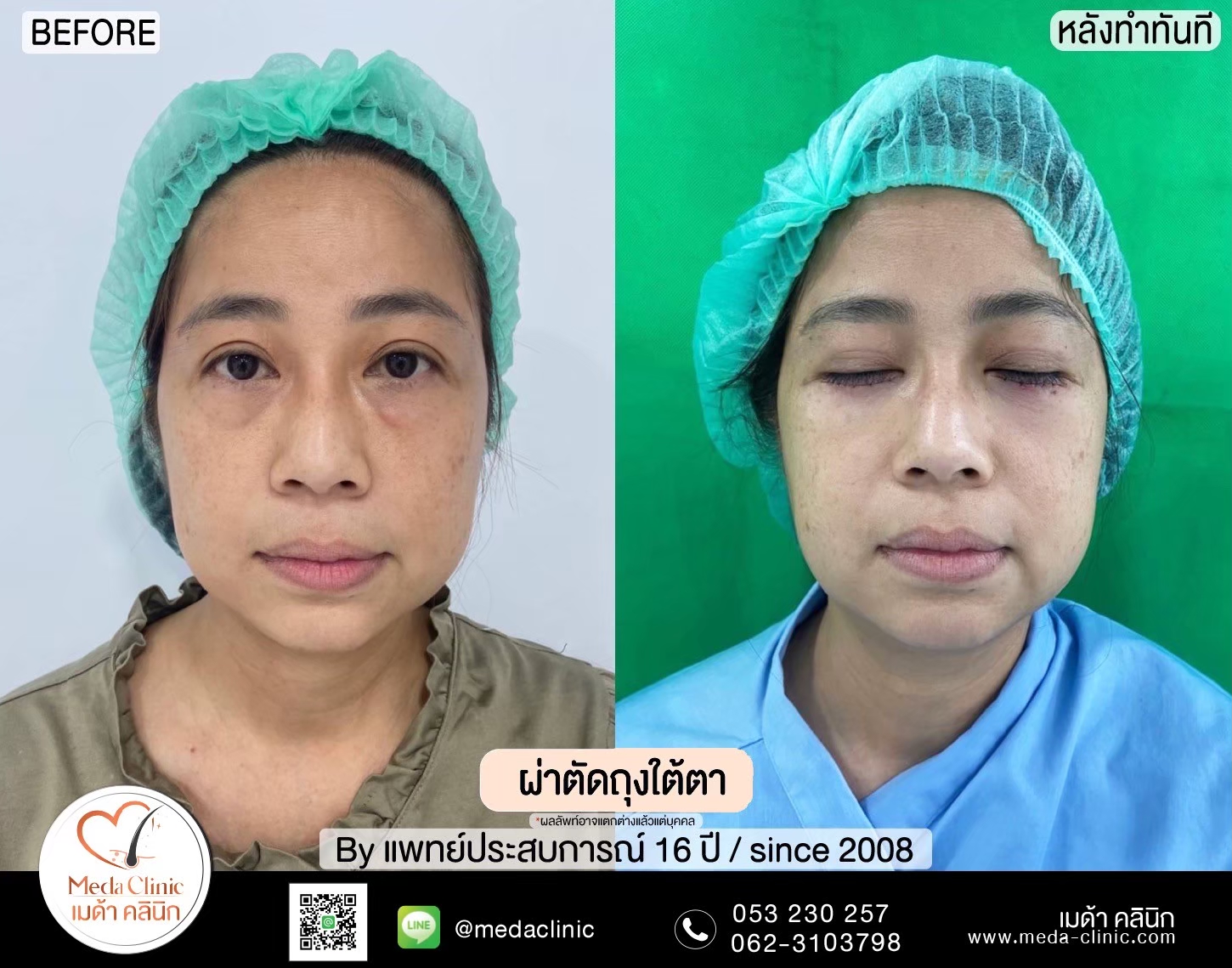 Lower Blepharoplasty