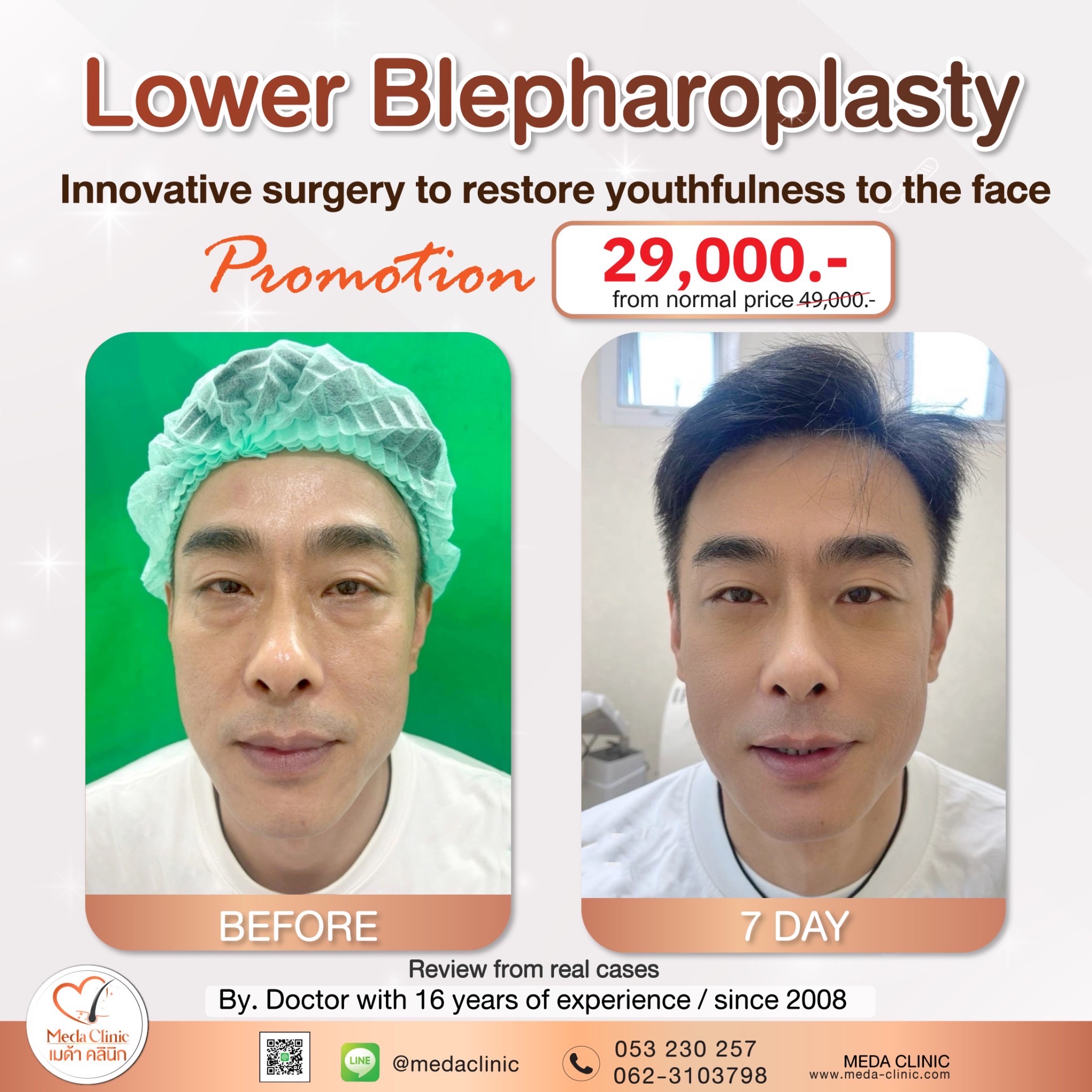 promotionLower Blepharoplasty