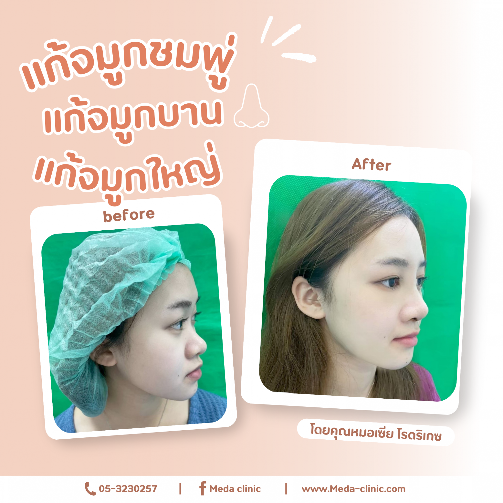 แก้จมูก
