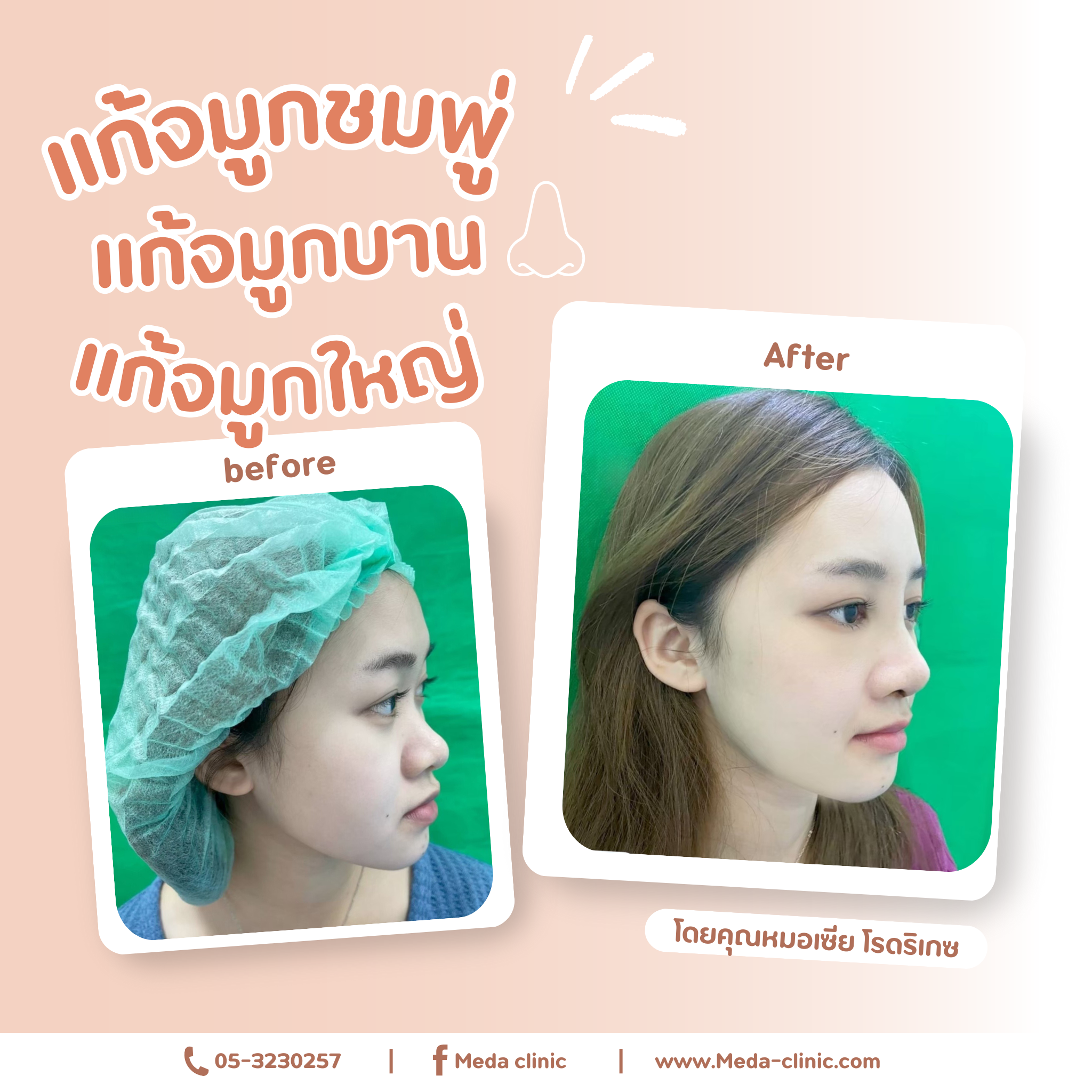 แก้จมูก