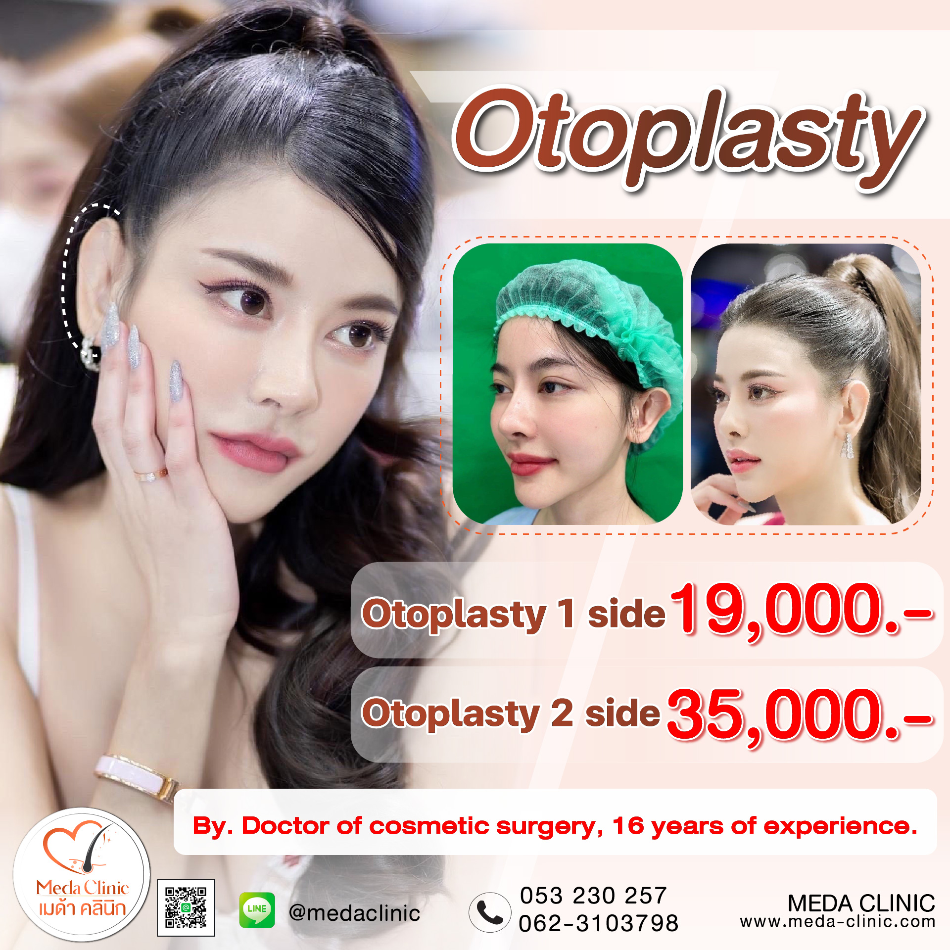 Otoplasty