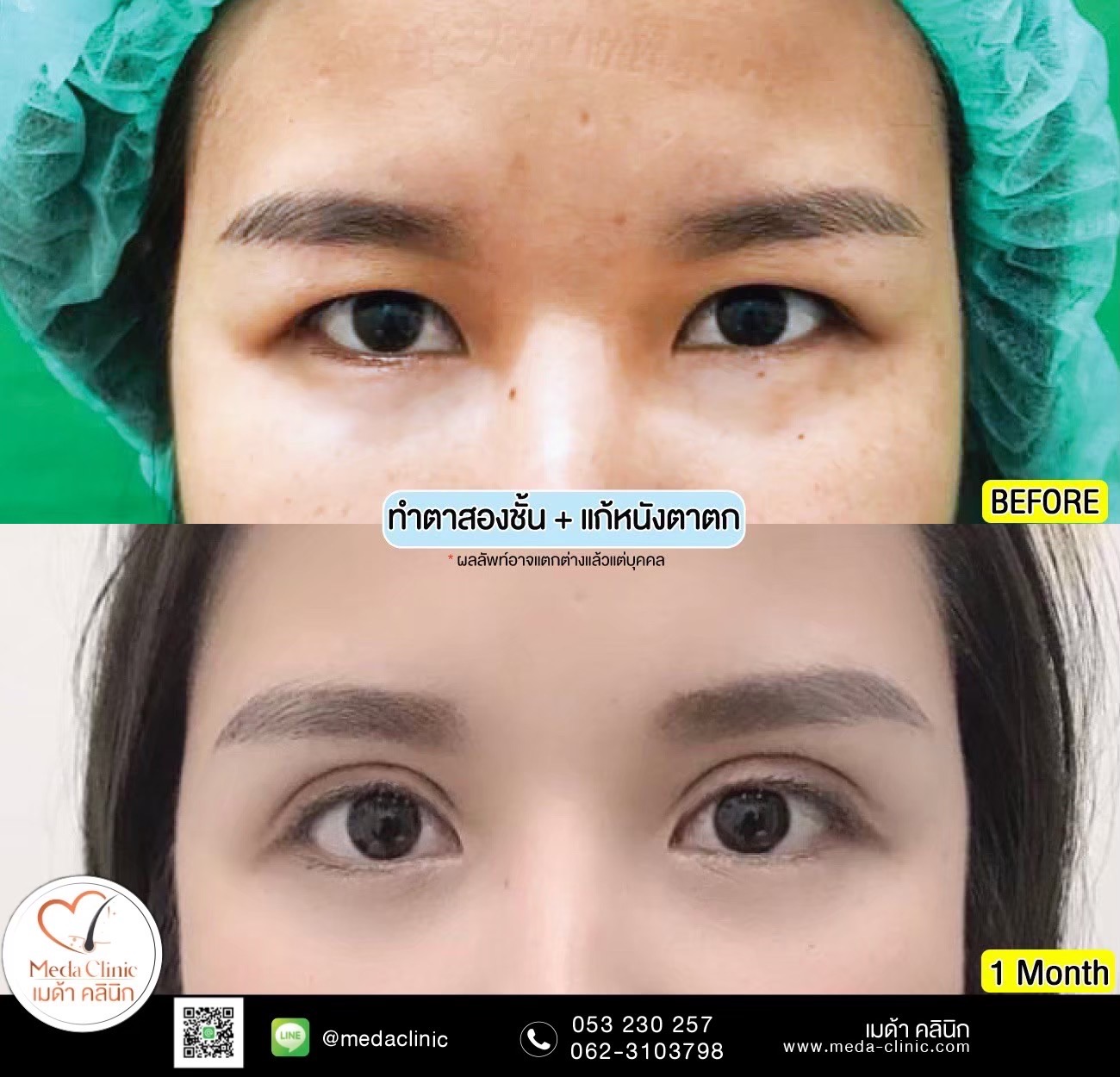 ทำตาสองชั้นเชียงใหม่