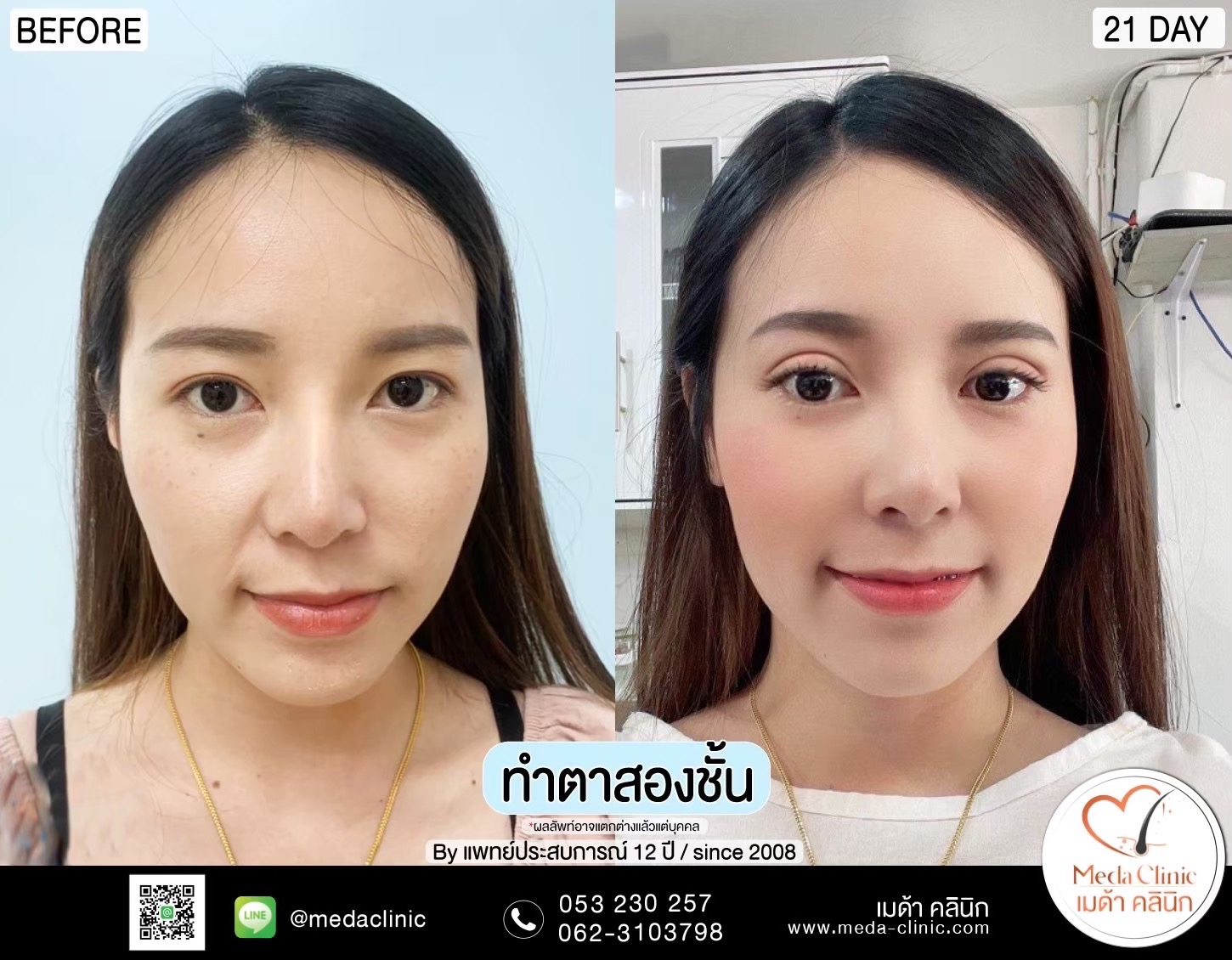 รีวิวทำตาสองชั้น