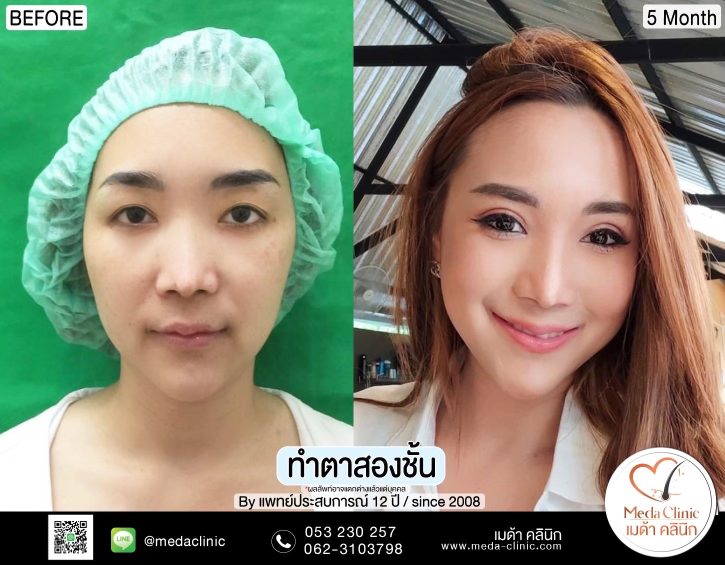 Double Eyelid Surgery Chiang Mai