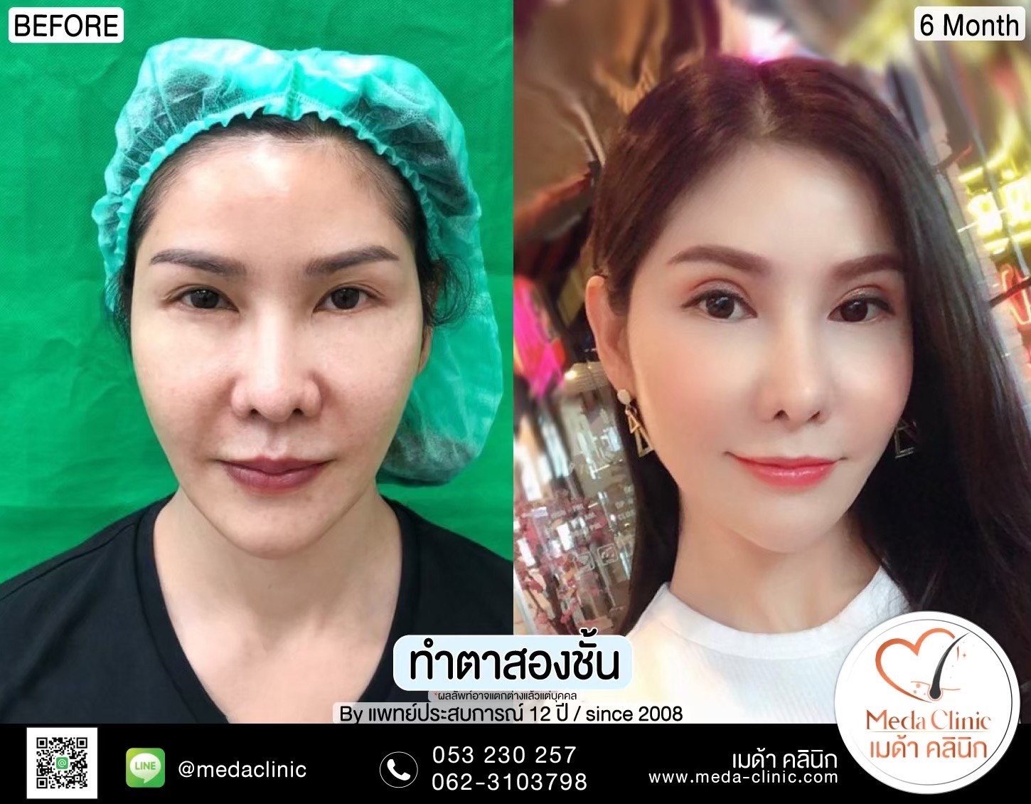 Double Eyelid Surgery Chiang Mai