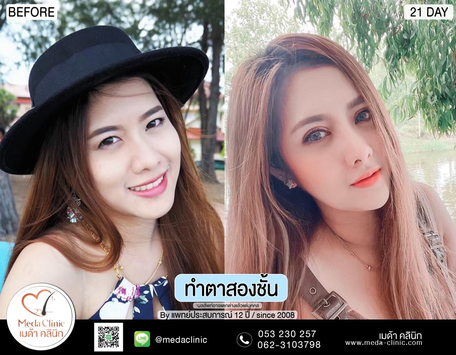 Double Eyelid Surgery Chiang Mai