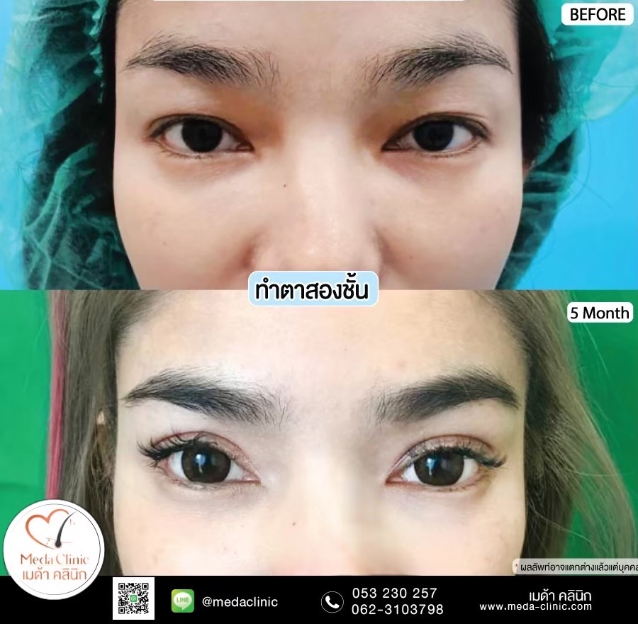 Double Eyelid Surgery Chiang Mai