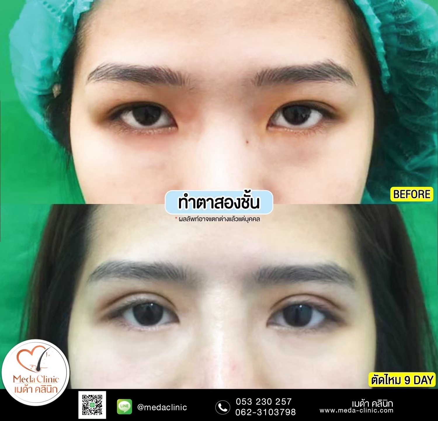 Double Eyelid Surgery Chiang Mai