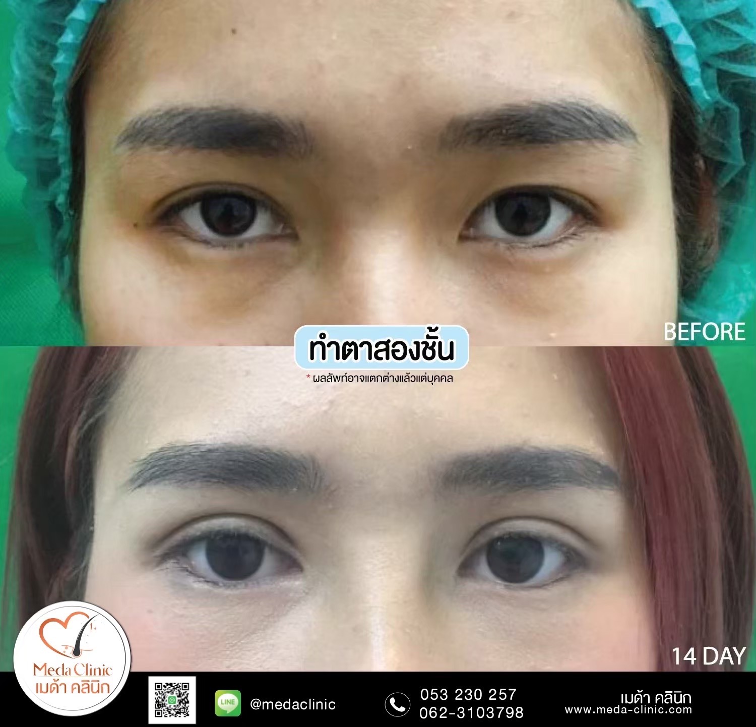 Double Eyelid Surgery Chiang Mai