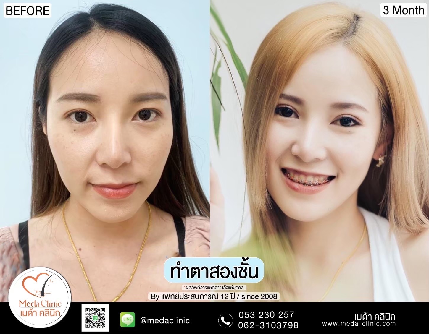 Double Eyelid Surgery Chiang Mai