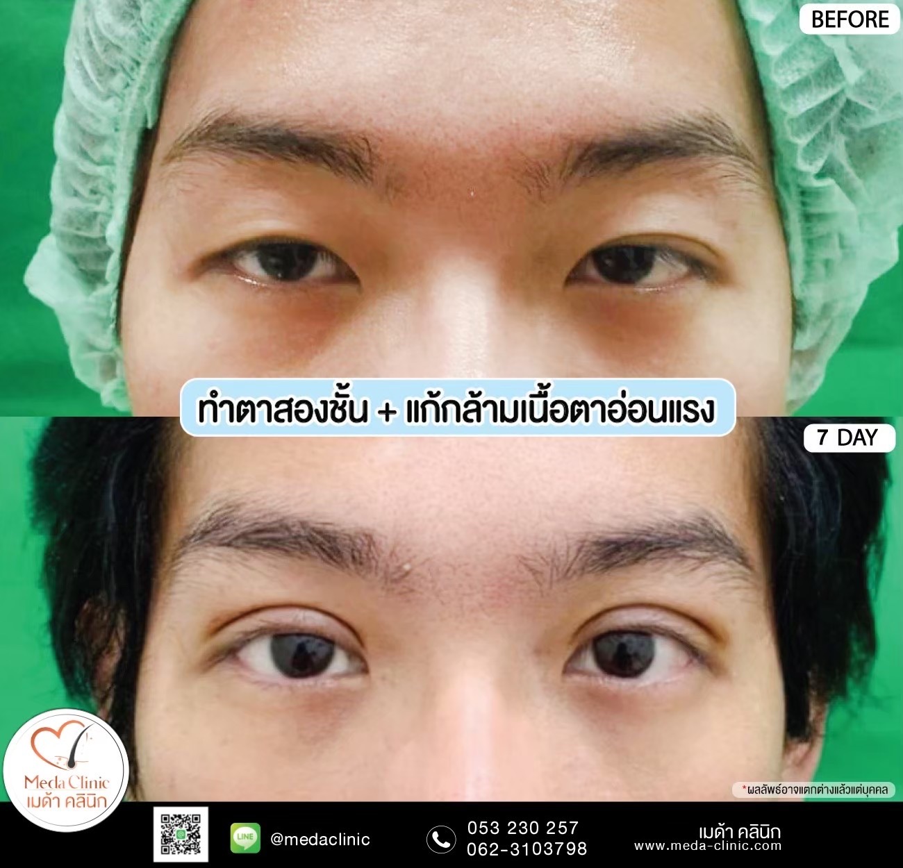 Double Eyelid Surgery Chiang Mai