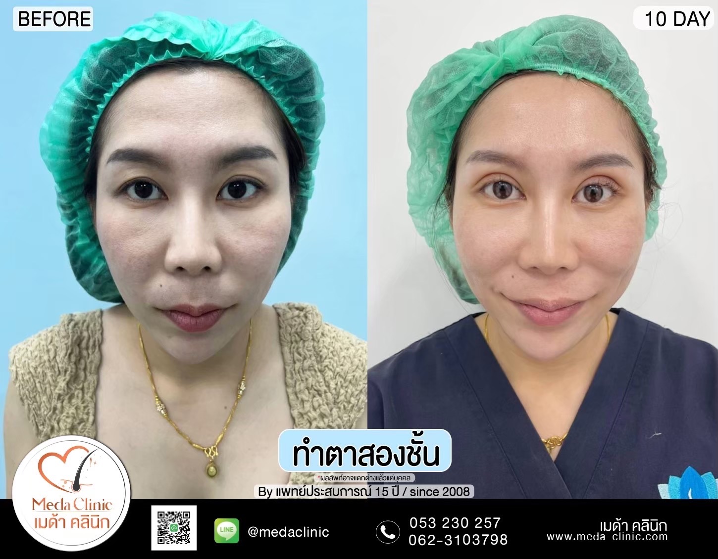 Double Eyelid Surgery Chiang Mai