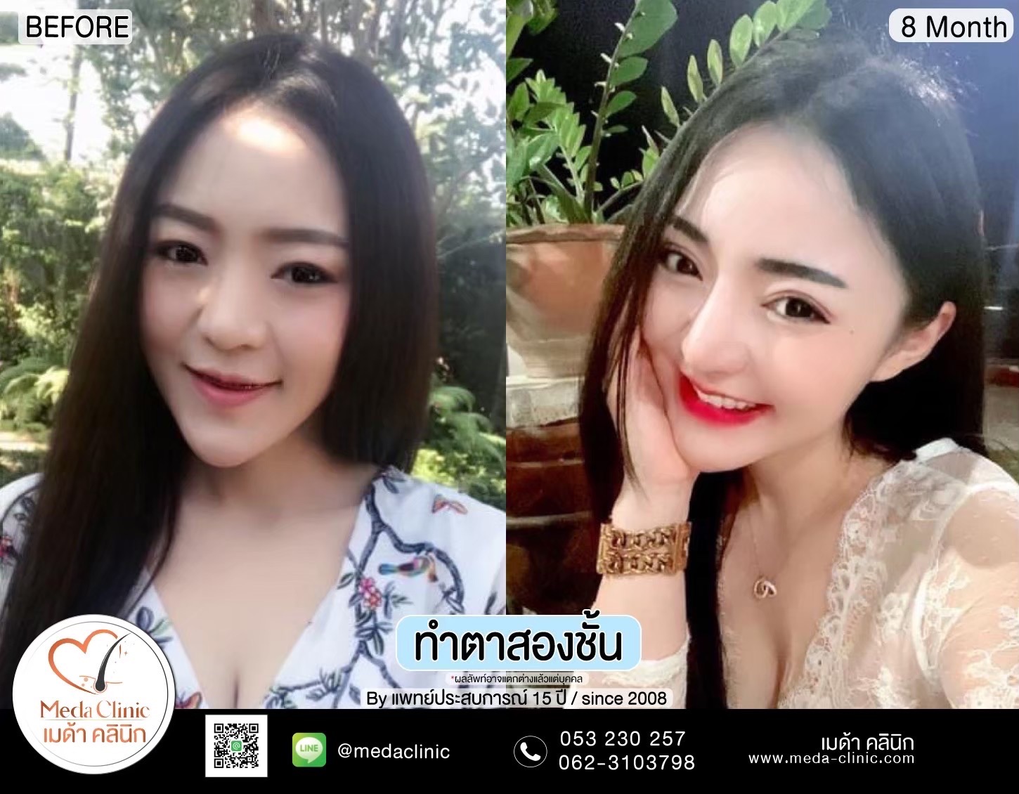 Double Eyelid Surgery Chiang Mai