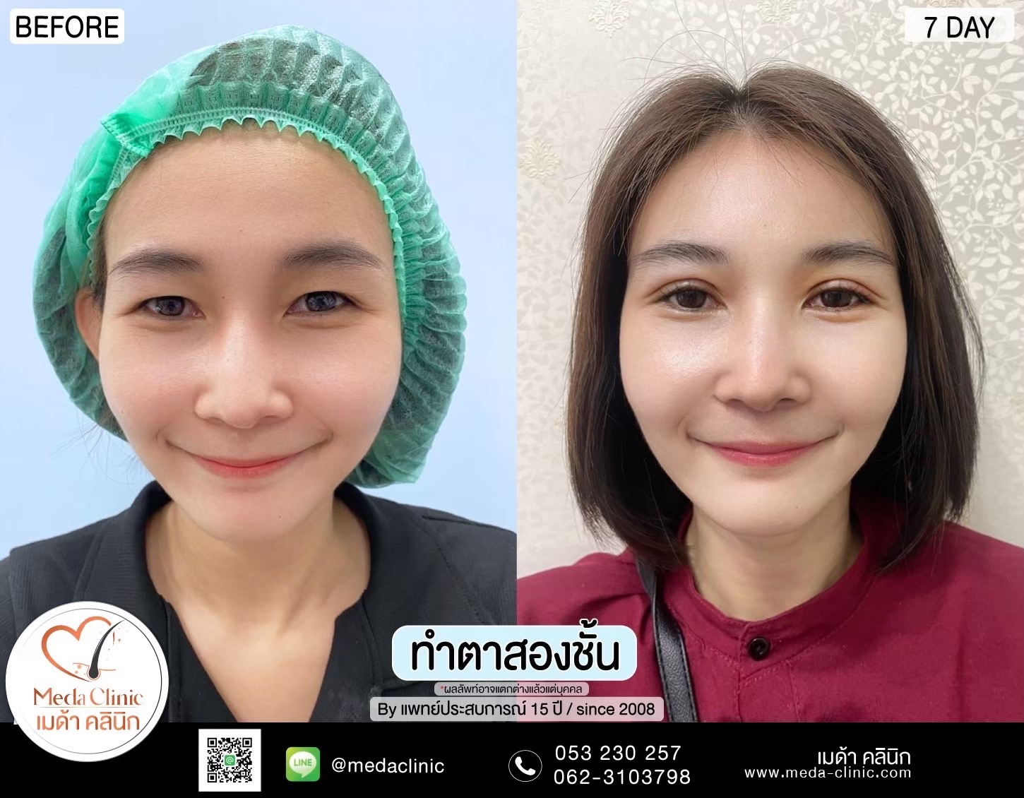 Double Eyelid Surgery Chiang Mai