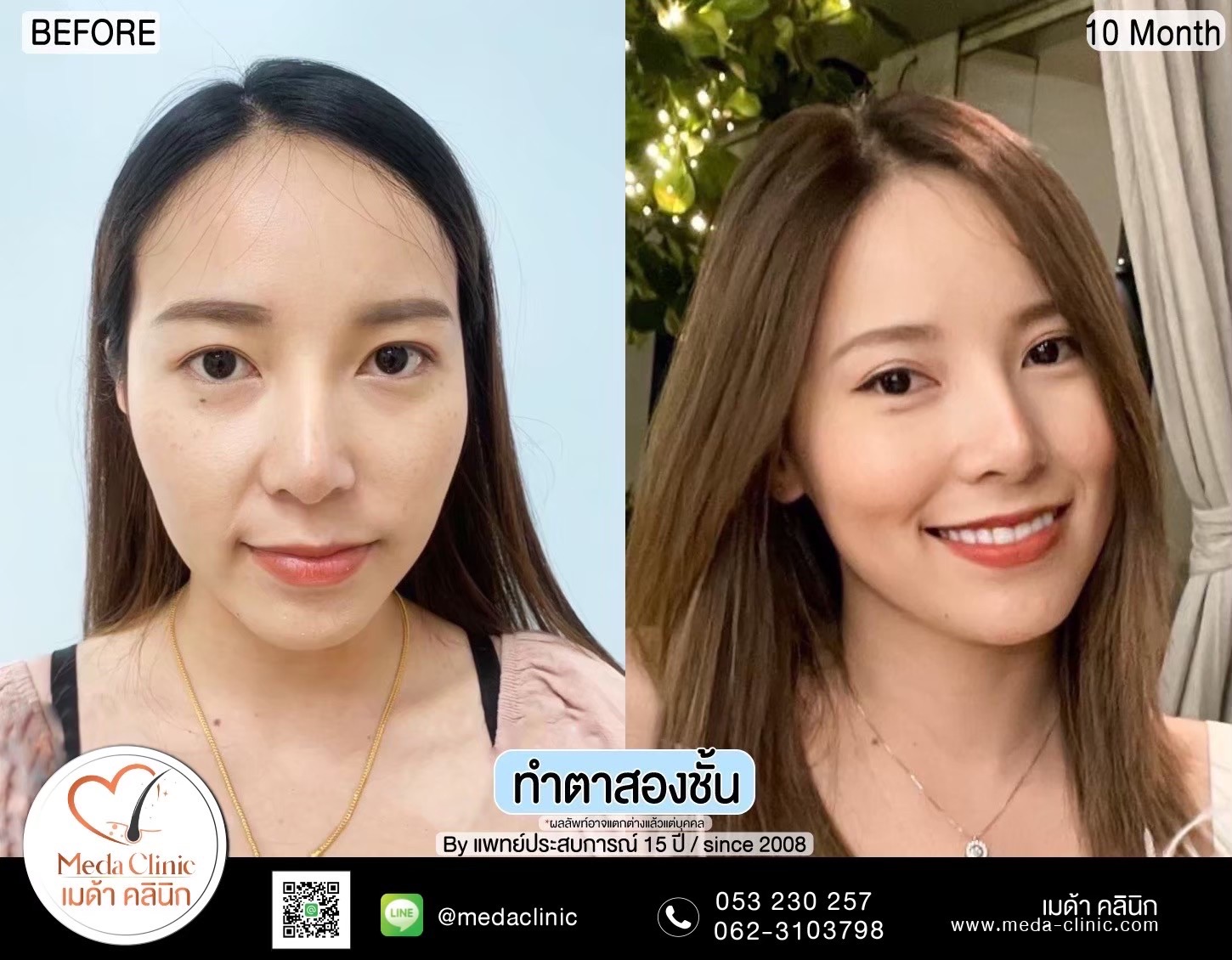 Double Eyelid Surgery Chiang Mai