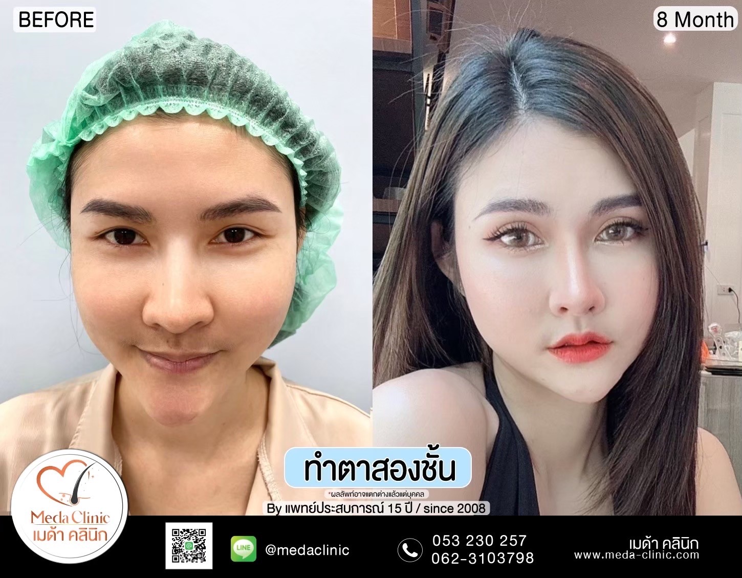 Double Eyelid Surgery Chiang Mai