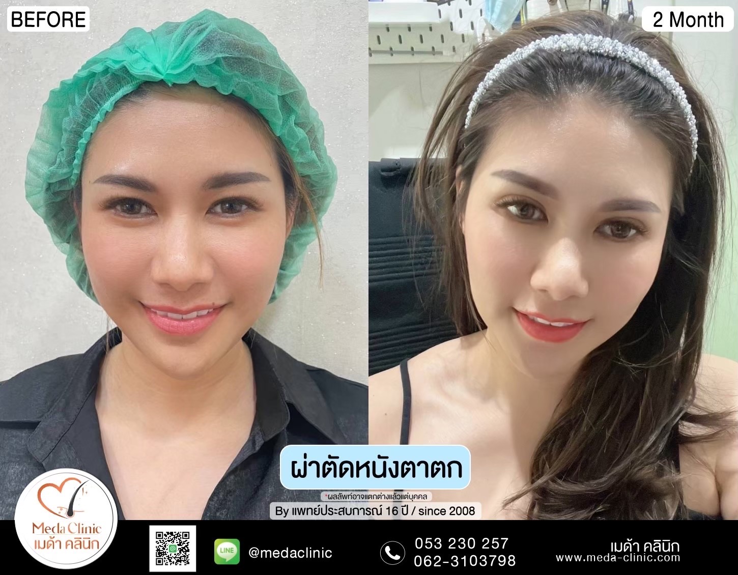 Double Eyelid Surgery Chiang Mai