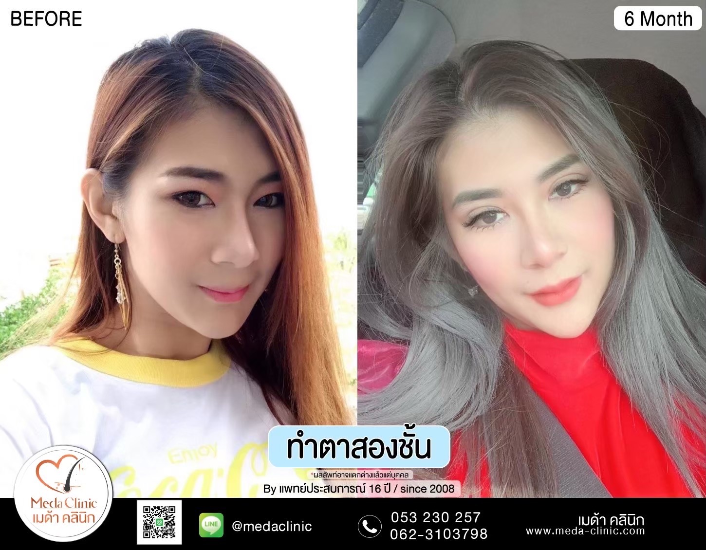 Double Eyelid Surgery Chiang Mai