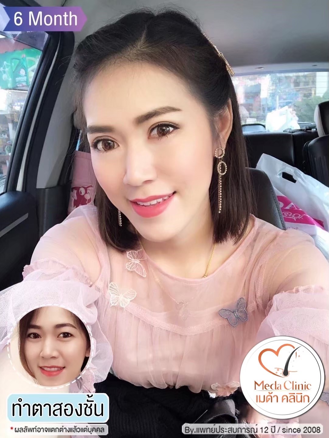 Double Eyelid Surgery Chiang Mai