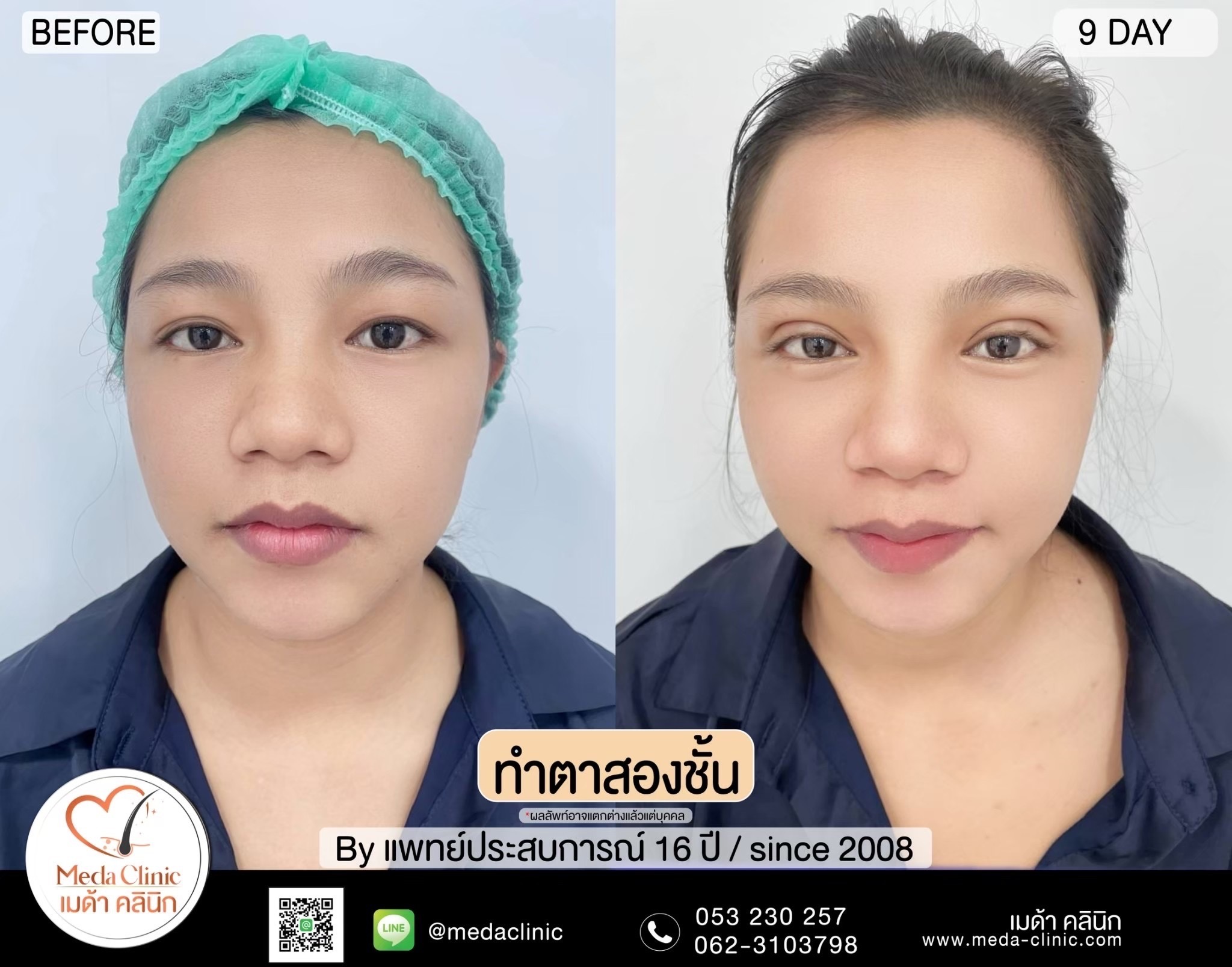 Double Eyelid Surgery Chiang Mai