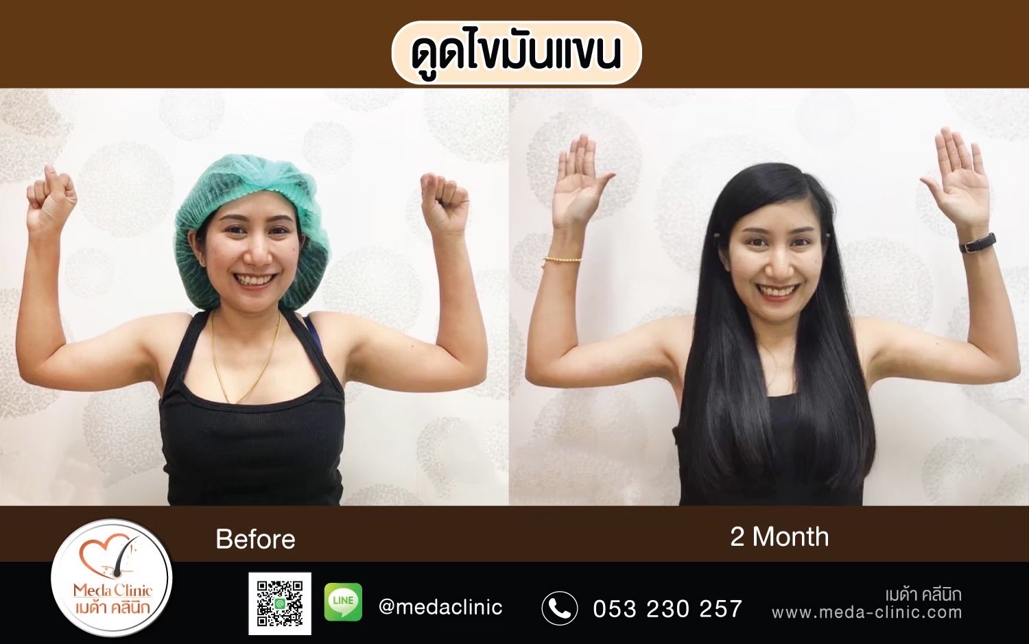 Liposuction Chiang Mai