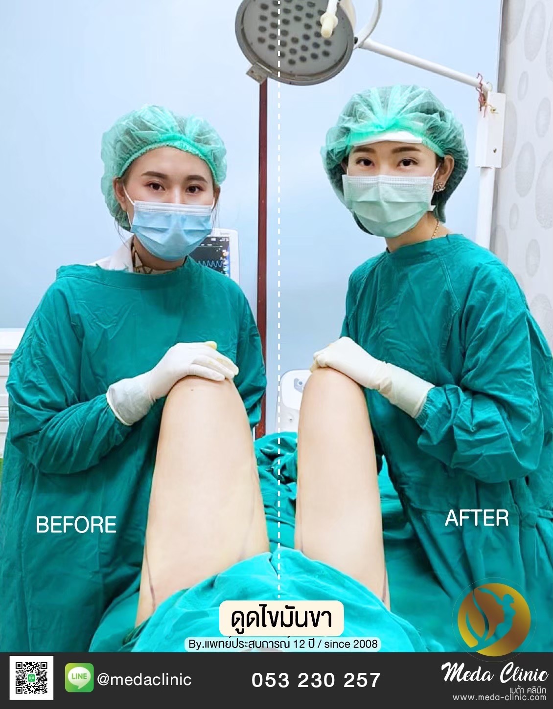 Liposuction Chiang Mai