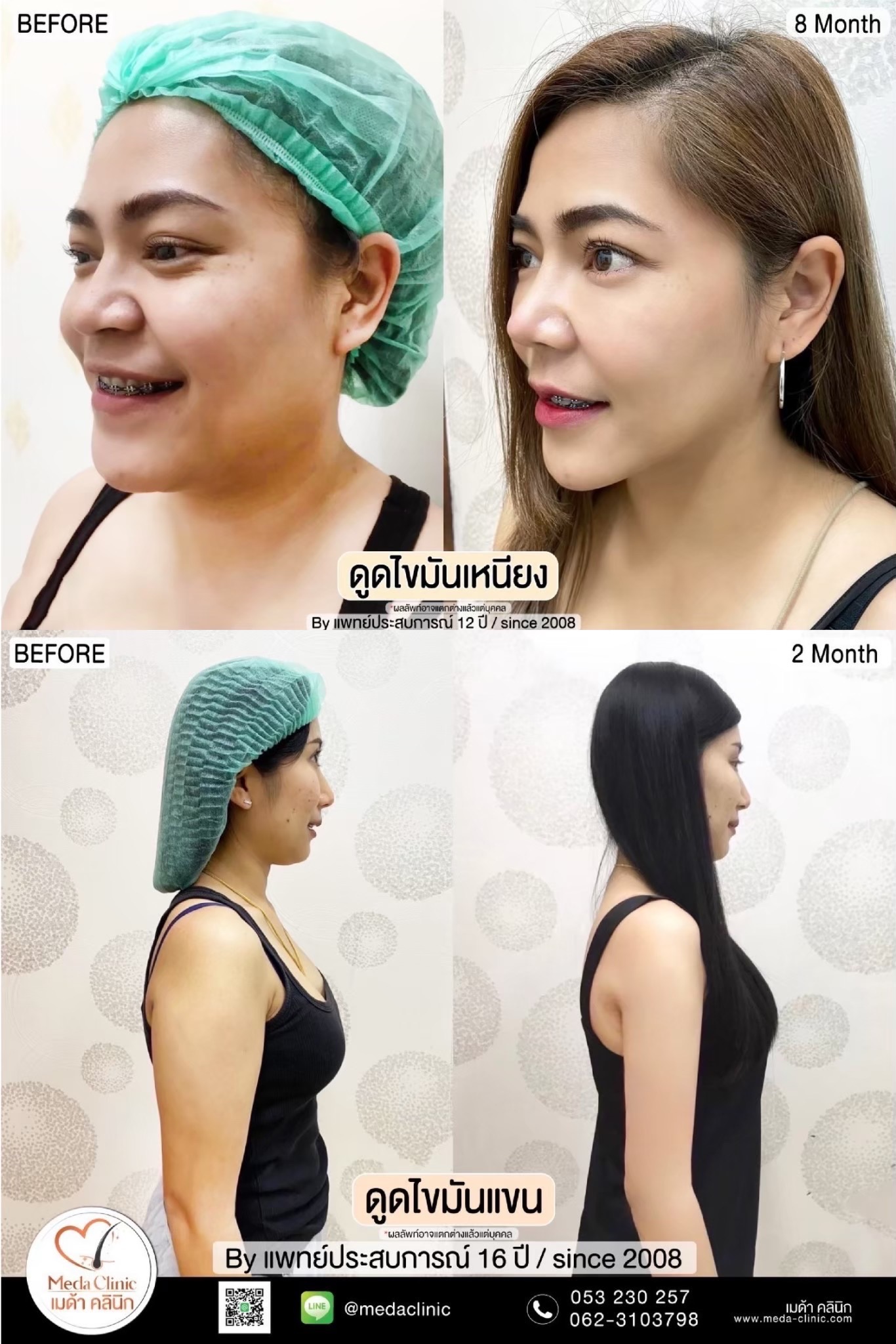 Liposuction Chiang Mai