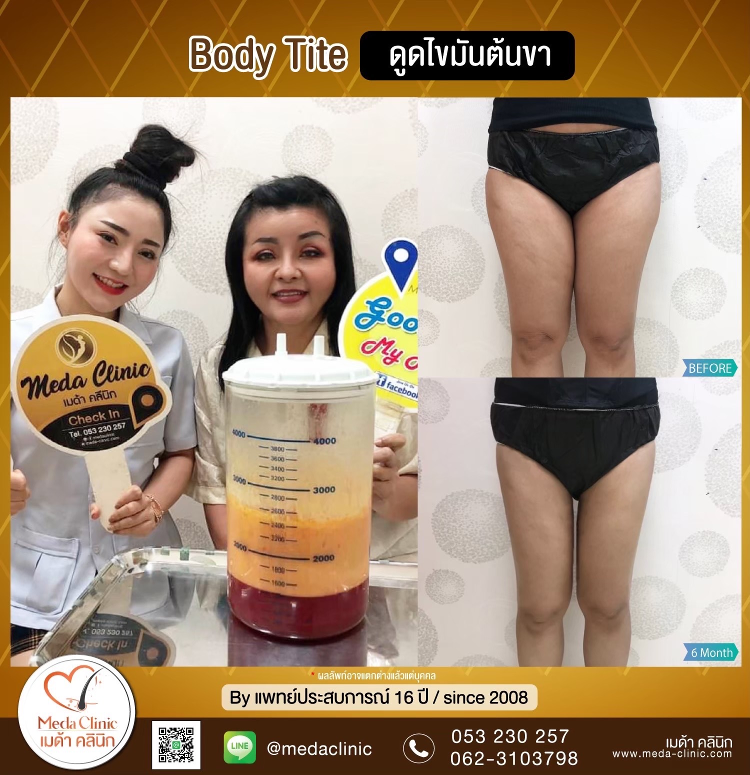 Liposuction Chiang Mai