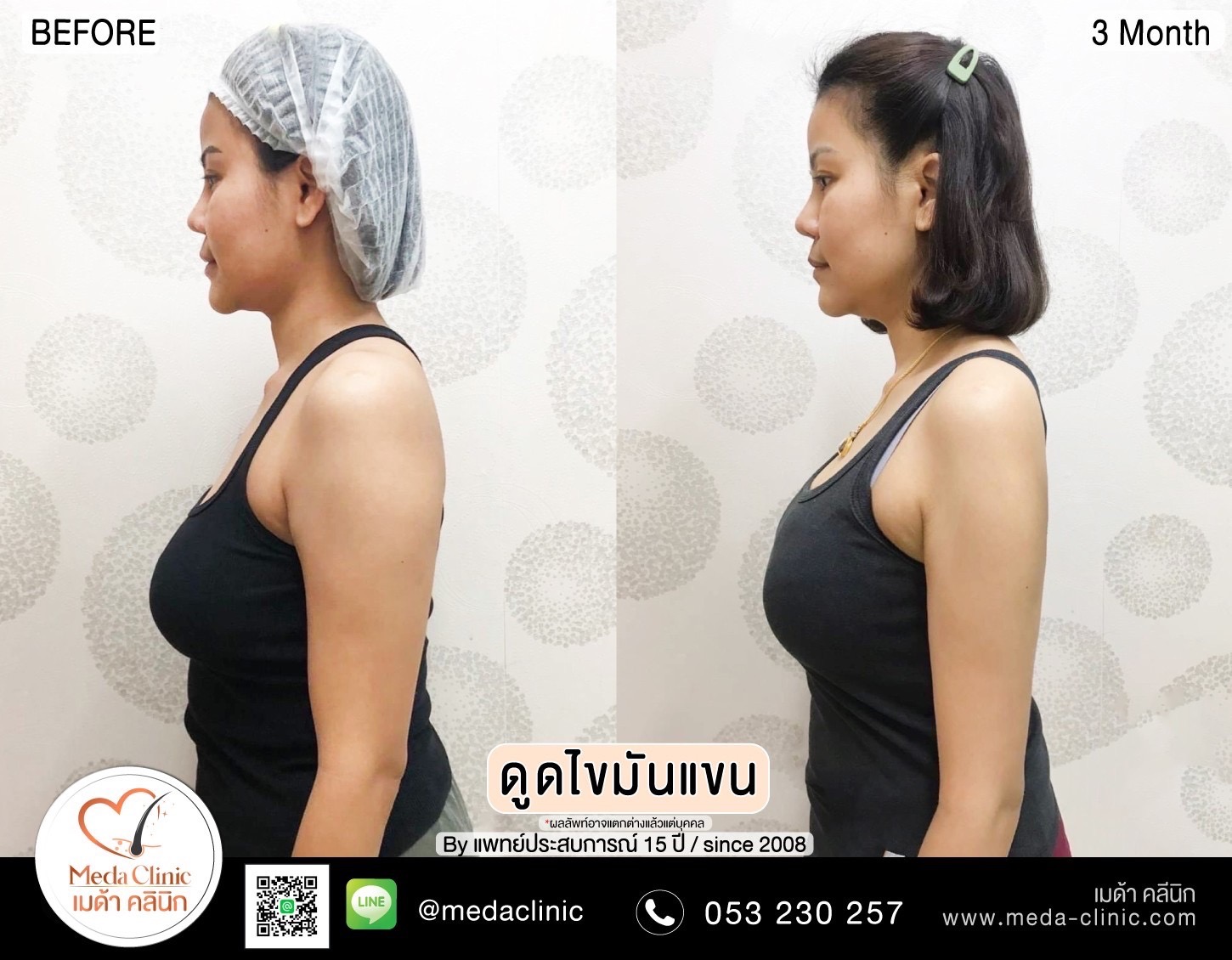 Liposuction Chiang Mai
