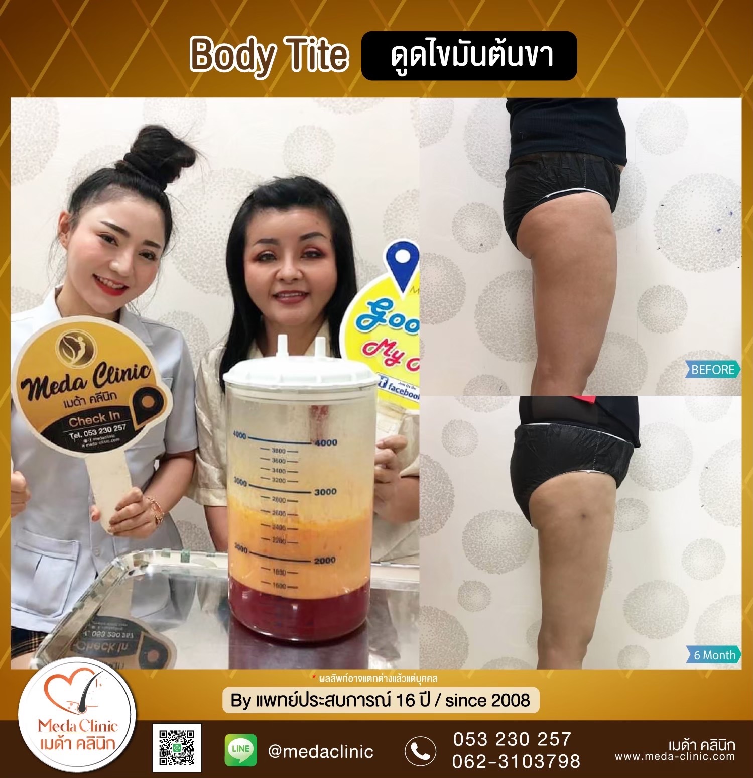 Liposuction Chiang Mai