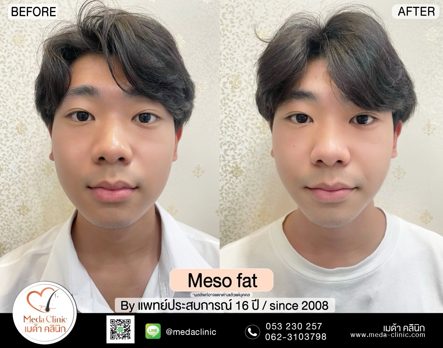Meso Fat
