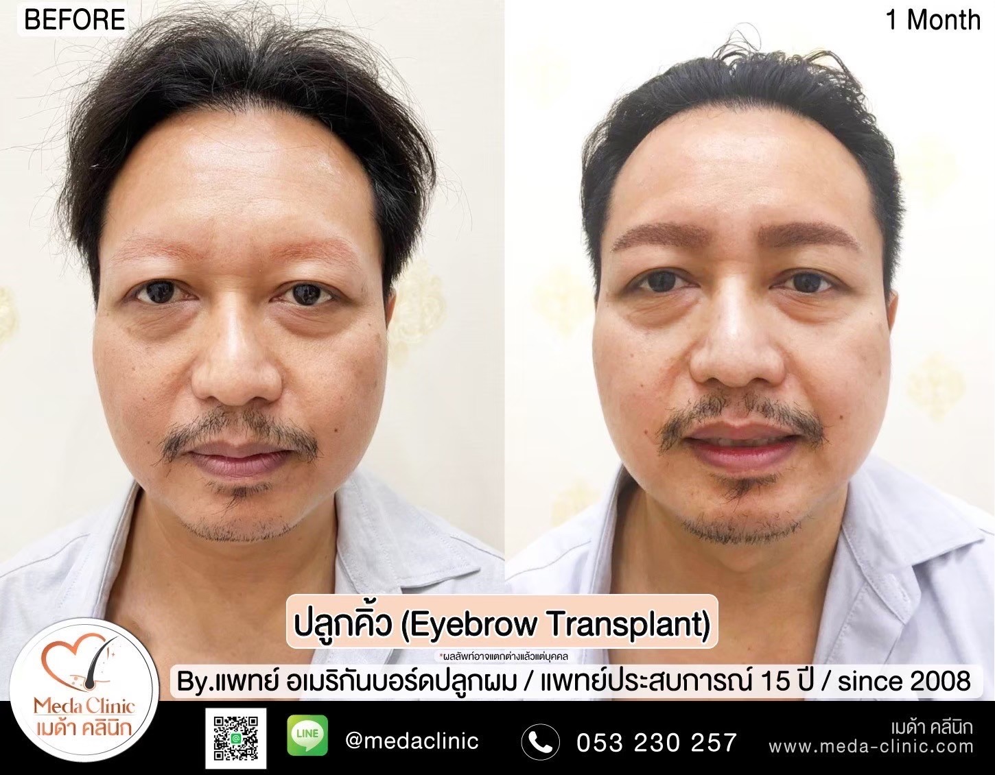 Eyebrow transplant Chiang Mai