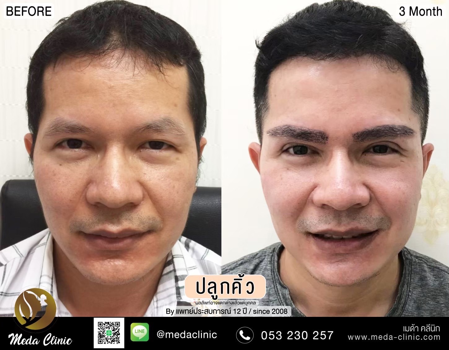 Eyebrow transplant Chiang Mai