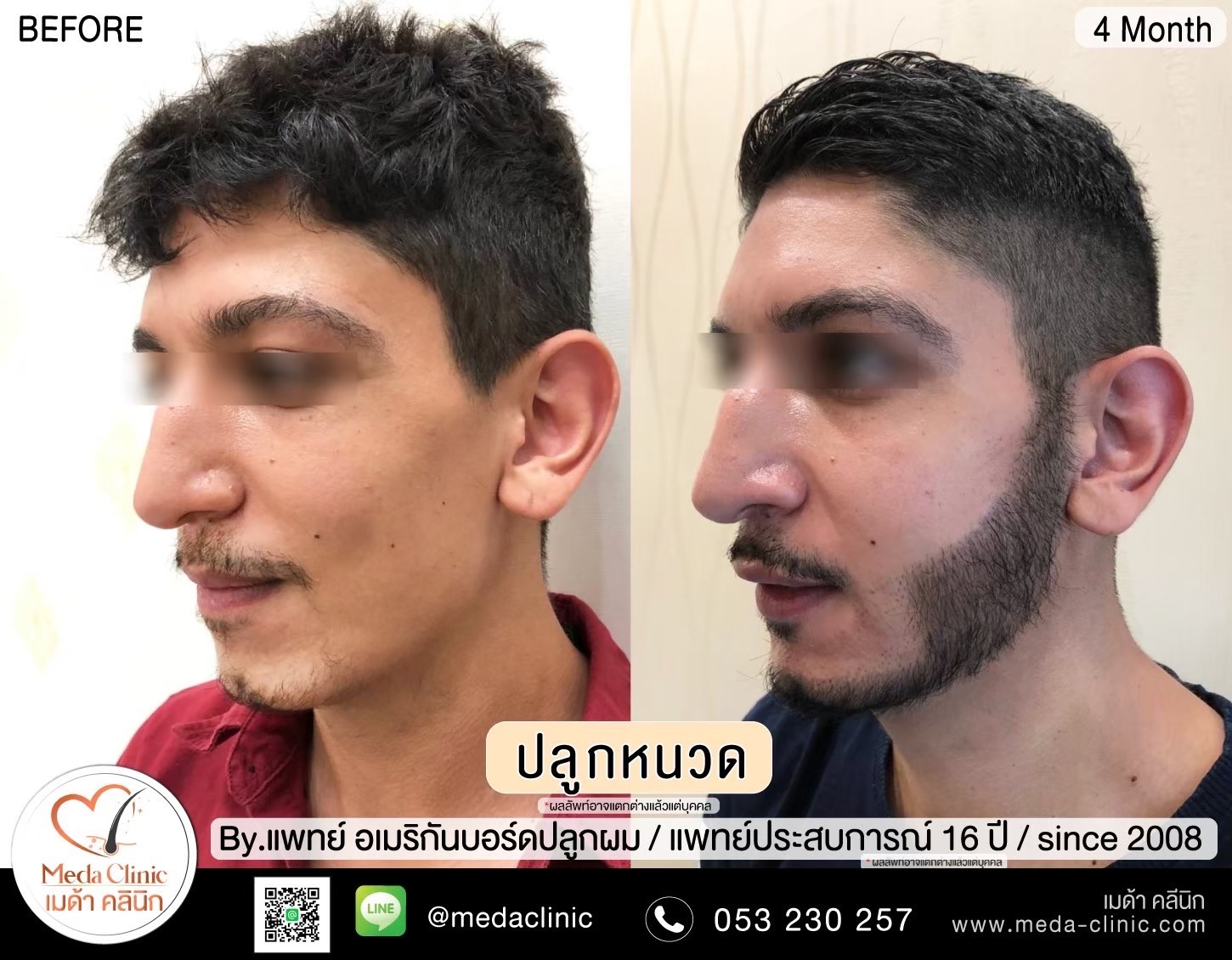 Eyebrow transplant Chiang Mai