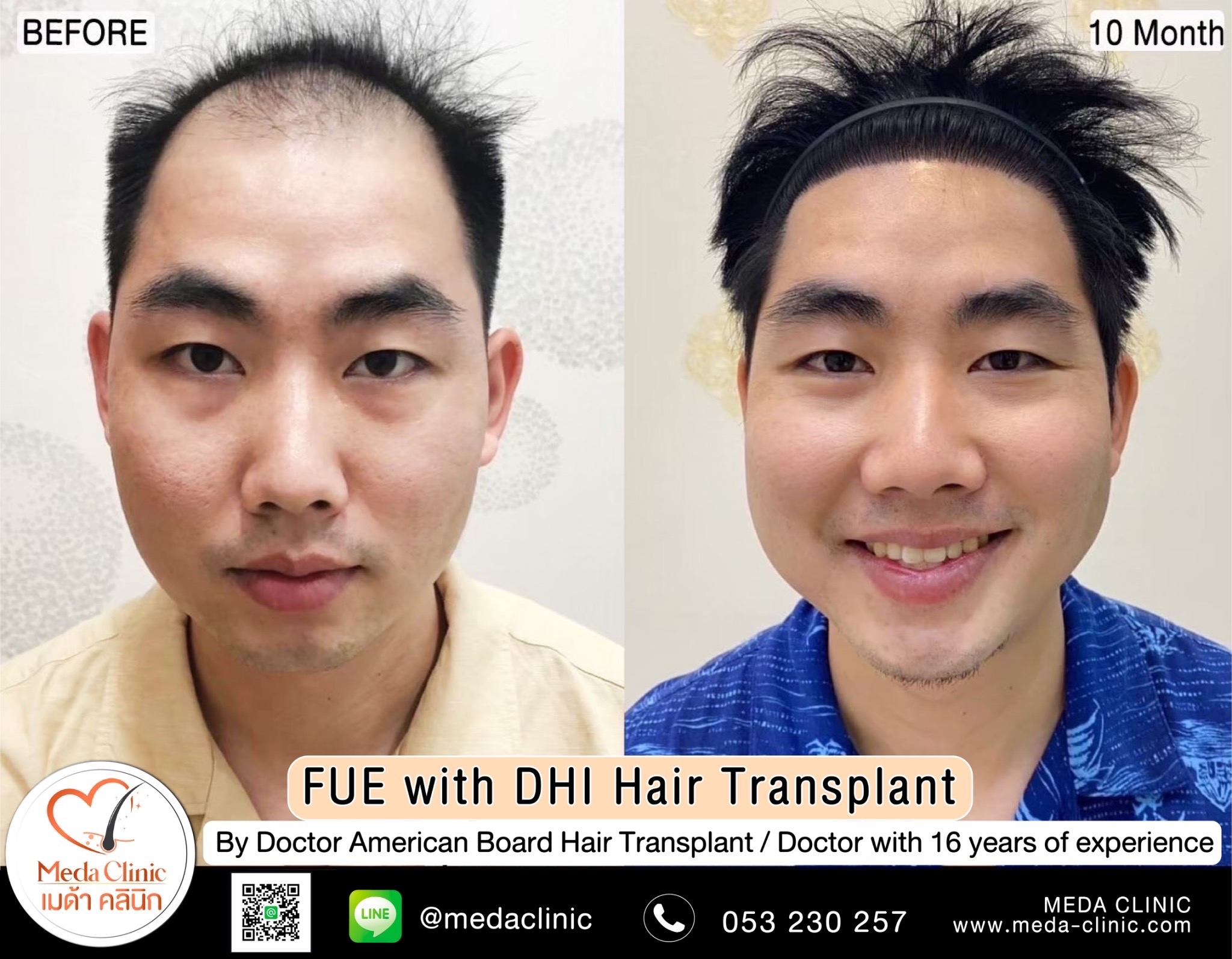 Eyebrow transplant Chiang Mai