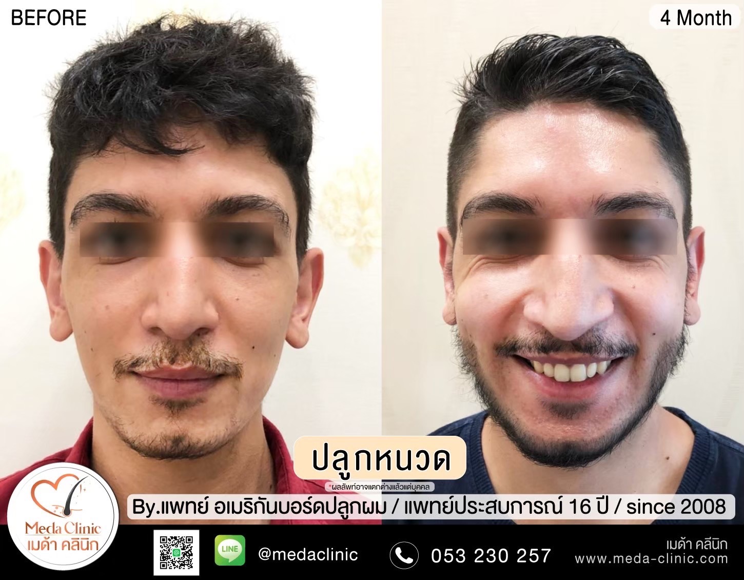 Eyebrow transplant Chiang Mai