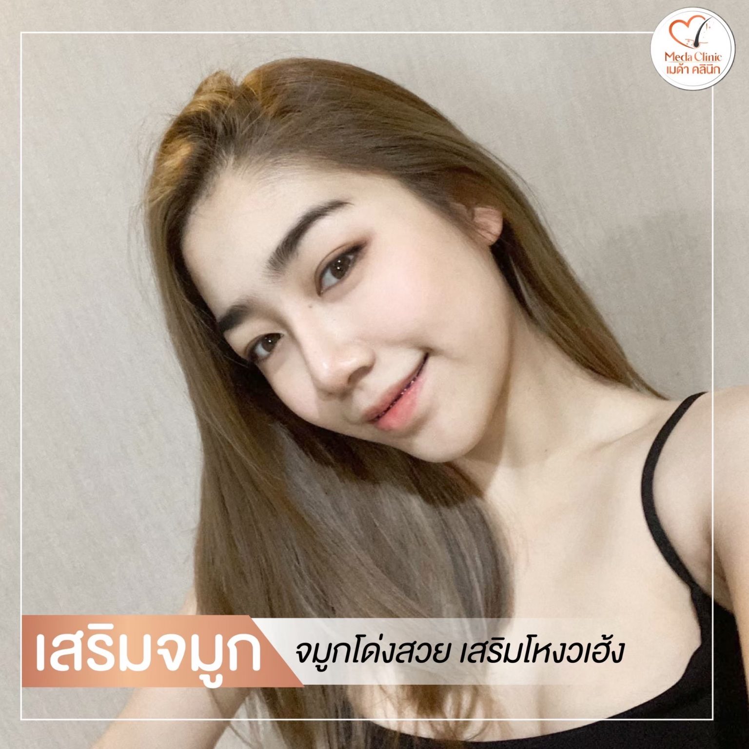 เสริมจมูก