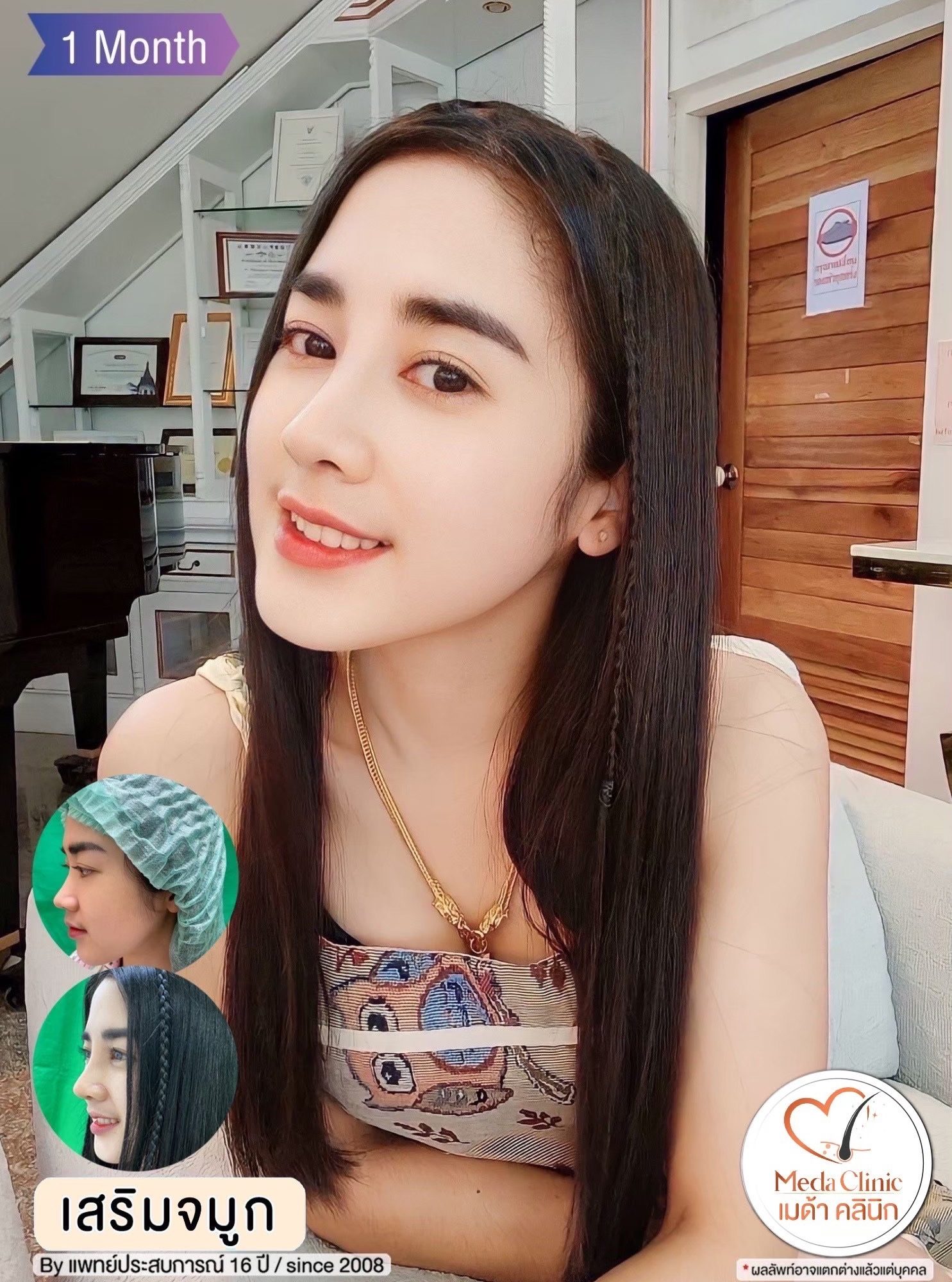 เสริมจมูก