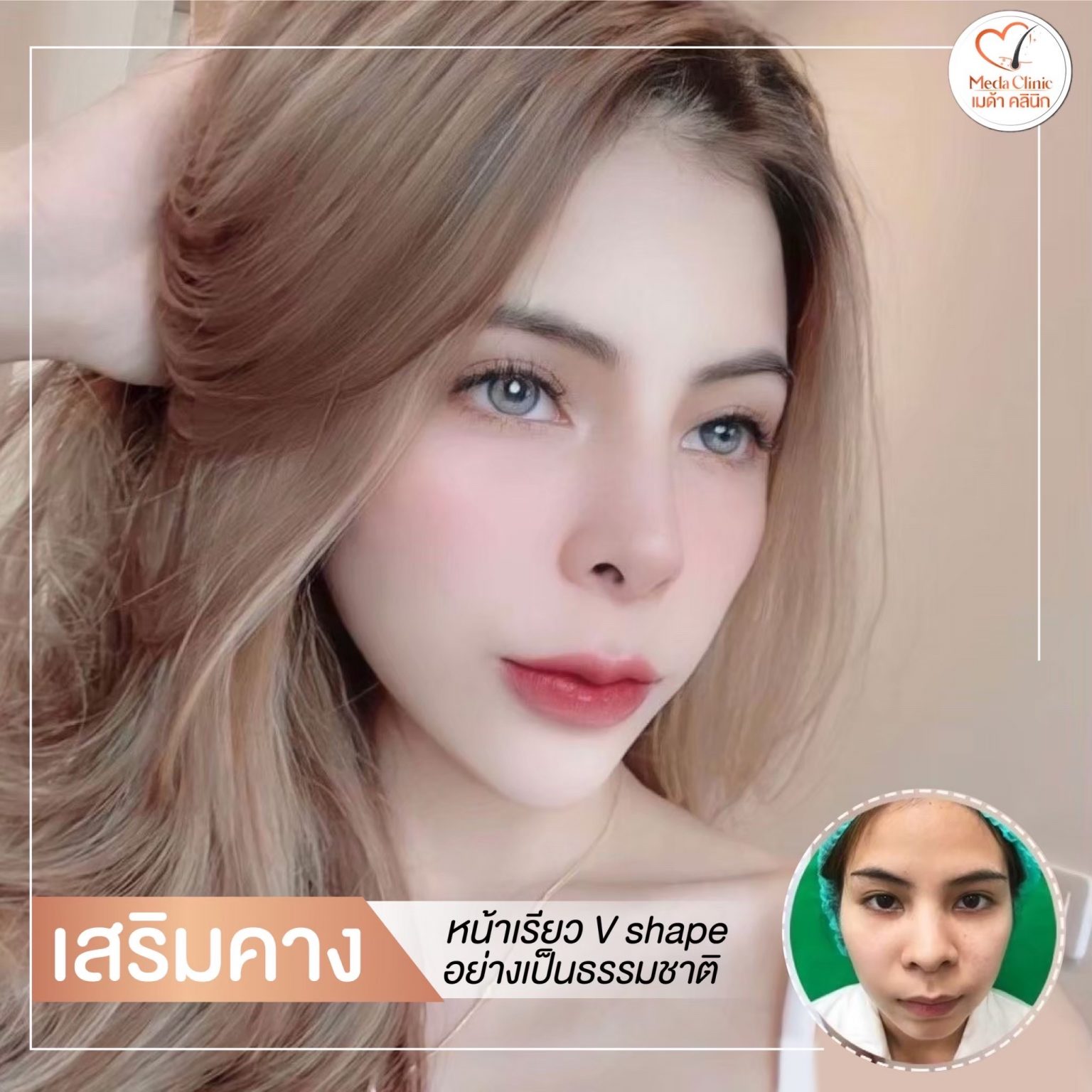 แก้คางเชียงใหม่
