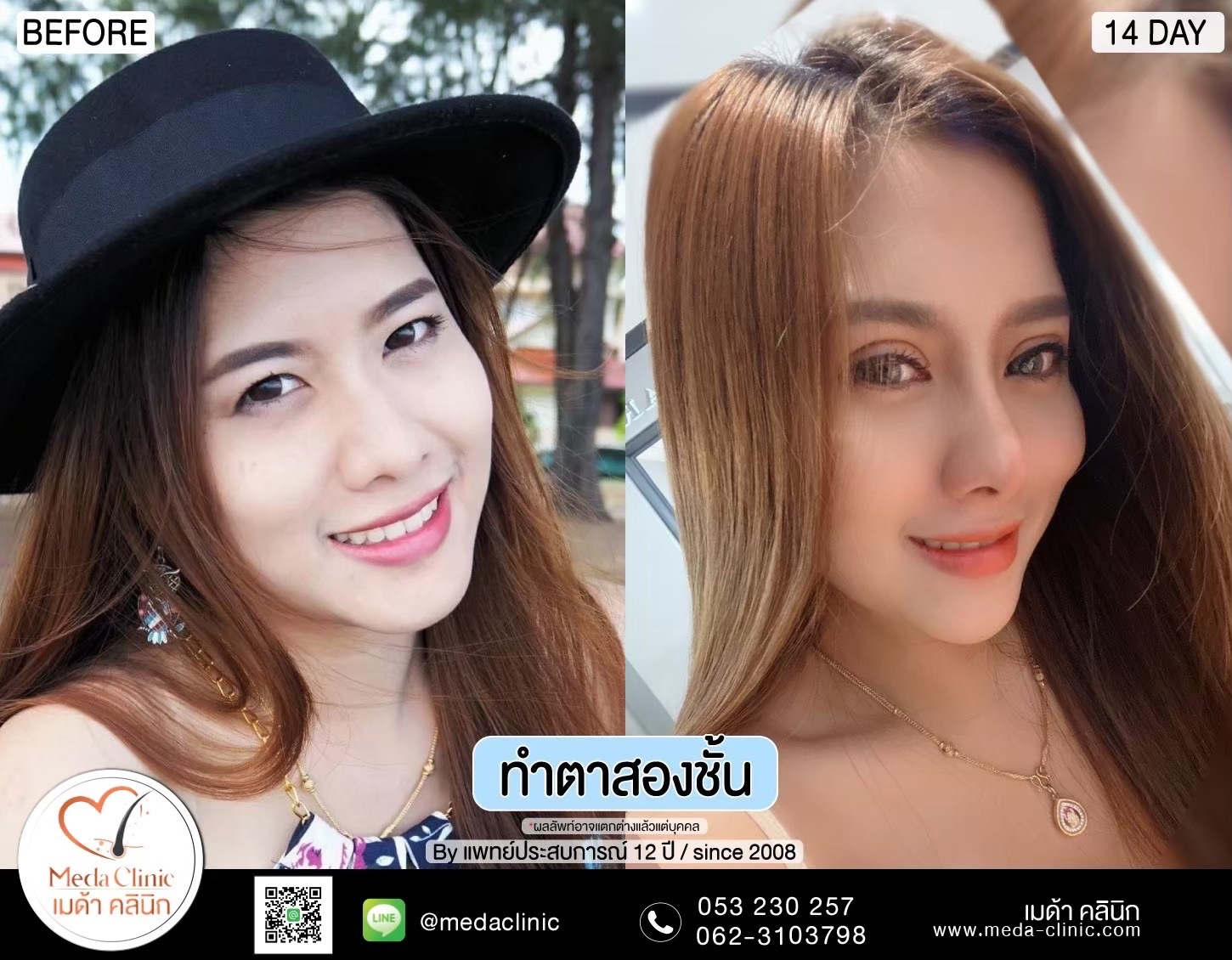 ผ่าตัดยกหางตา
