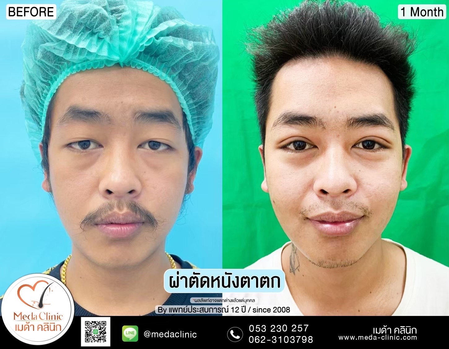ผ่าตัดยกหางตา