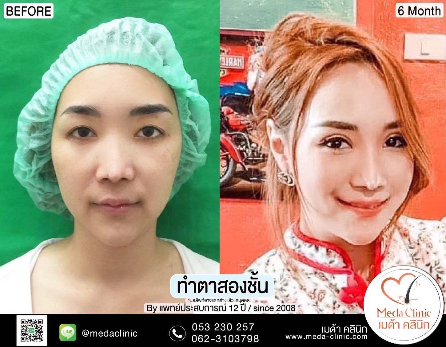 ผ่าตัดยกหางตา