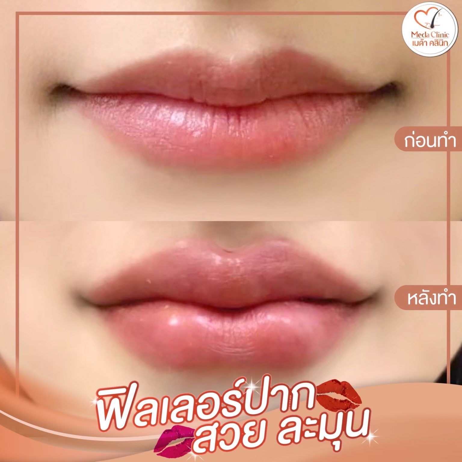 ฟิลเลอร์ปากเชียงใหม่